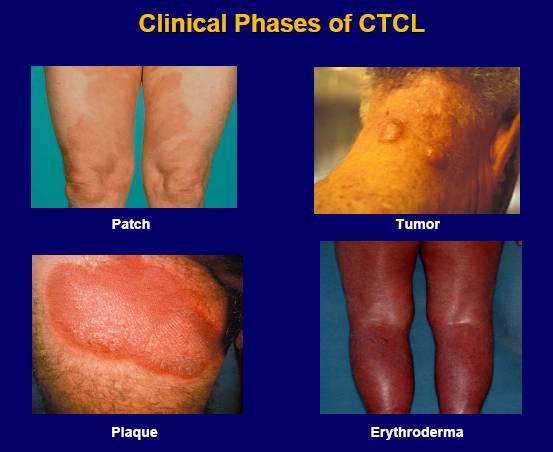 Clinical CTCL