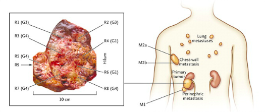 Figure 2: Regions of biopsies sampled from the primary kidney tumor (marked as R) and metastatic locations (marked as M). (From Gerlinger et al, 2012). http://www.nejm.org/doi/full/10.1056/nejmoa1113205#t=article