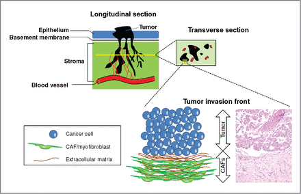 Figure 3. The tumor invasion front. Observations on longitudinal sections (top-left corner) of cancers penetrating the host stroma show an octopus-like configuration of cancer spread. After penetrating the basement membrane, epithelial cancers migrate toward the underlying lymphatic or blood vessels, patterned in a branching morphology. In such areas within the stroma, transverse section (yellow line) may reveal patterns of cancer cell “islets”/“cohorts” (top-right corner). In this cartoon, cancer cell cohorts are depicted with black, blood vessels with red roundish shapes and stromal cells (CAFs) are depicted with the background green color. A magnification of the tumor-host cell interface area reveals 2 clearly distinguished subpopulations, the cancer population, and the myofibroblasts. The magnified area is depicted through both a cartoon (left schematic) and a histologic figure (right schematic), obtained from our archive. This interaction area is described as the “tumor invasion front” and it is characterized by “desmoplasia,” or “desmoplastic reaction,” a histopathological lesion defined as the peritumoral accumulation of CAFs with parallel deposition of ECM components. 